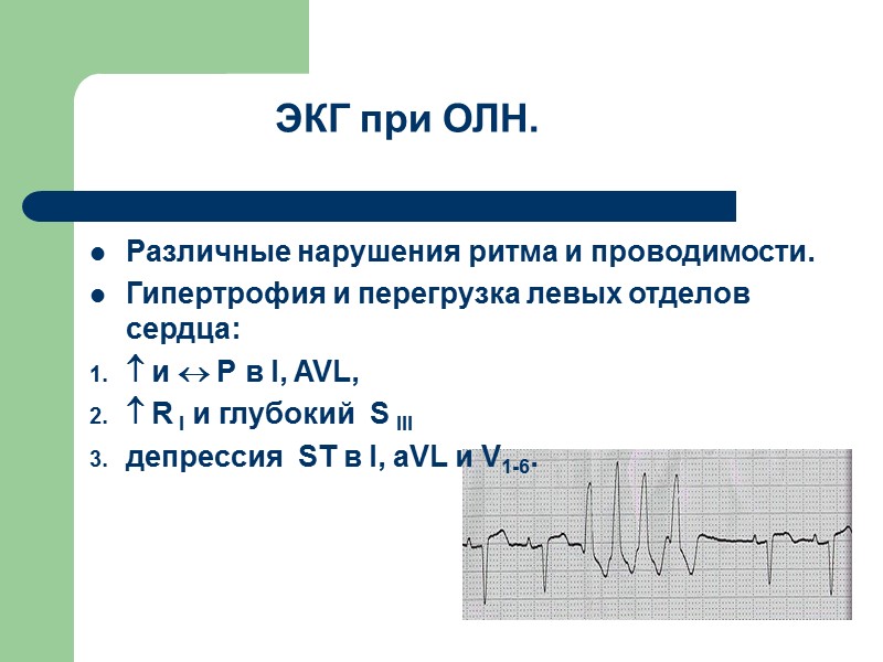 ЭКГ при ОЛН. Различные нарушения ритма и проводимости.  Гипертрофия и перегрузка левых отделов
